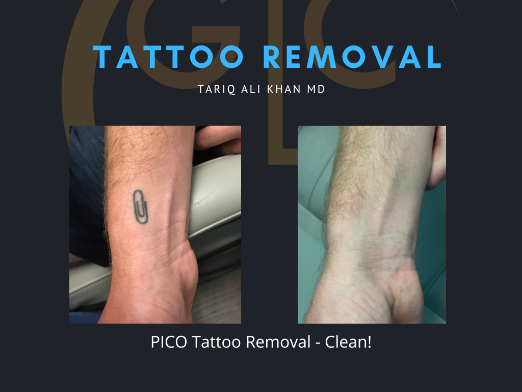 Gentle Care Laser Tustin & Long Beach Before and After picture - Tattoo Removal Mucosal Surface